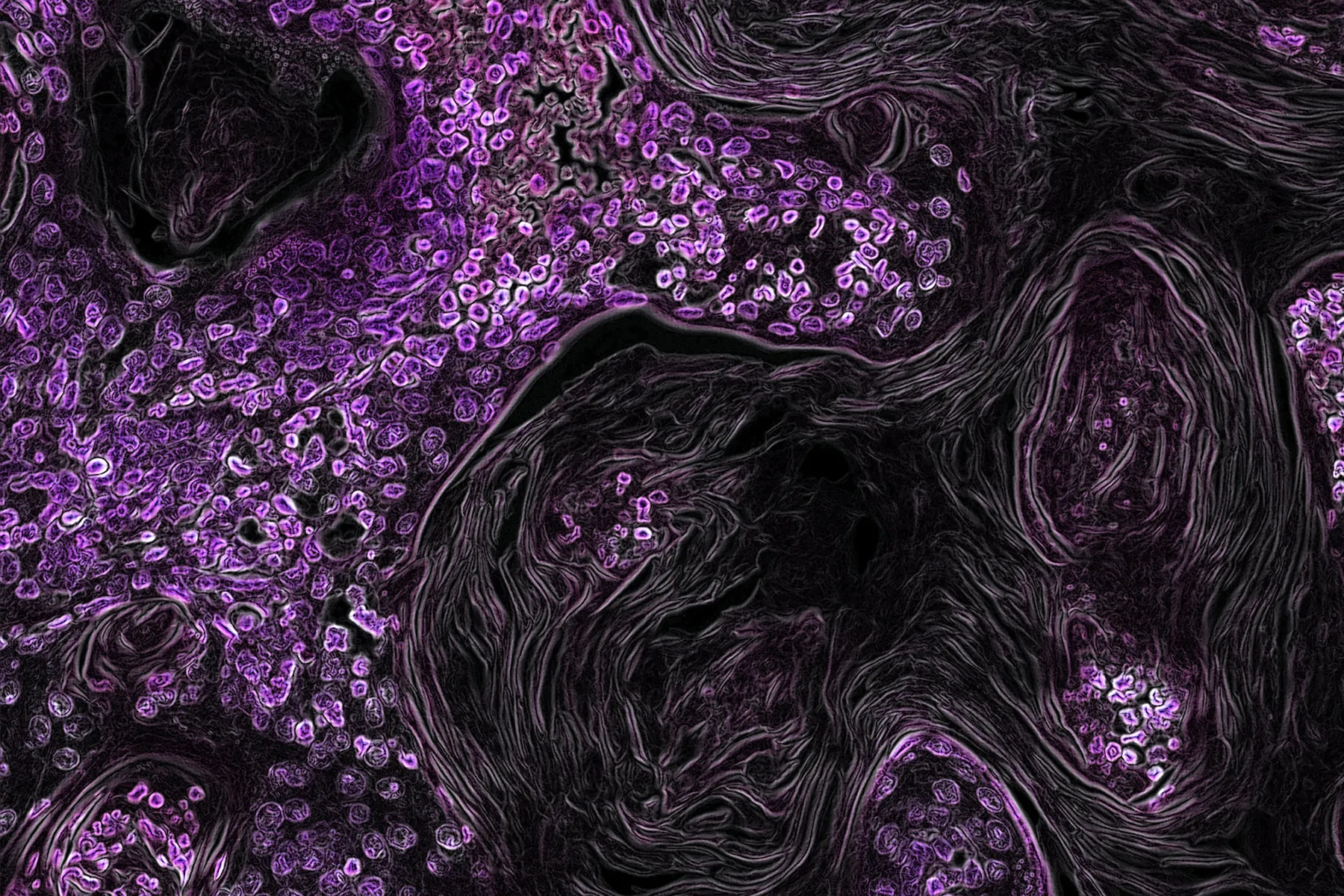 A microscope image showing purple cancer cells against a black background.
